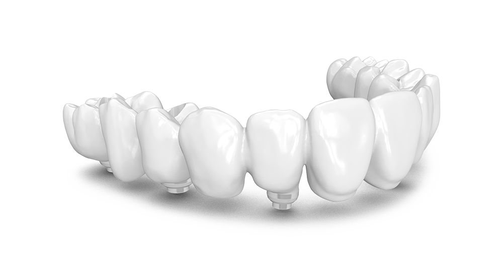 Colocación de Implantes Dentales navalcarnero